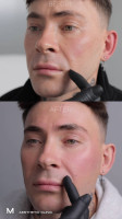 Plenhyage PDRN Before&After